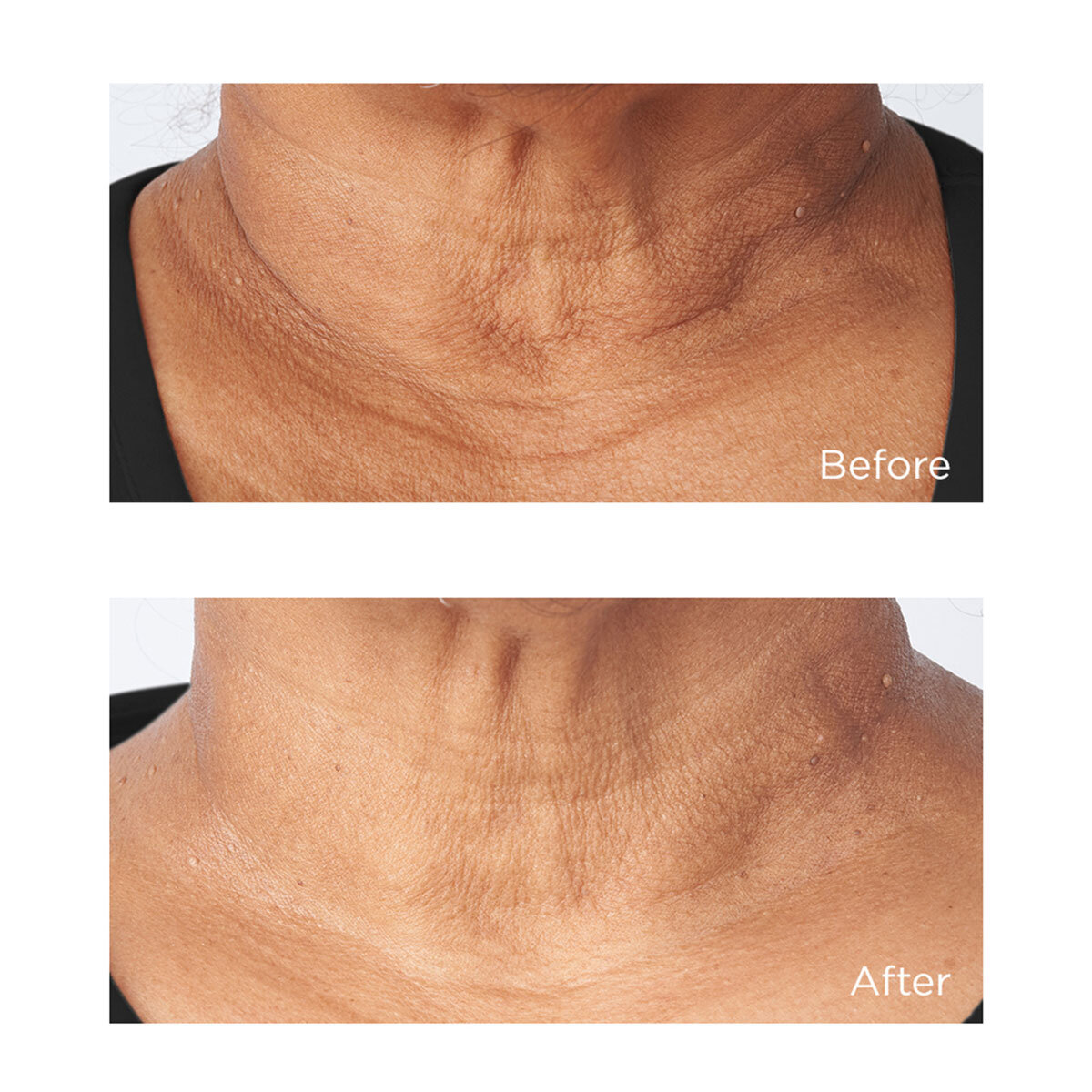Perricone MD, Cold Plasma Plus+ Sub-D/Neck Treatment, 59ML